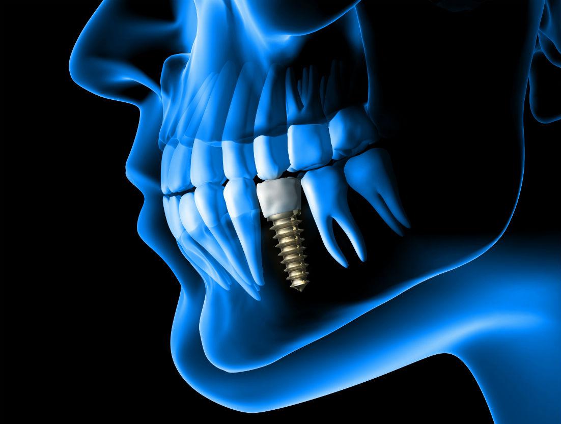 Dental Implants Tijuana